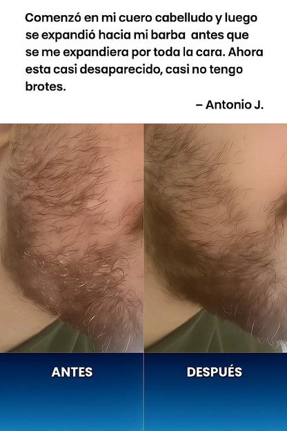 New aura — Barba Limpia, Suave y Sin Escamas.